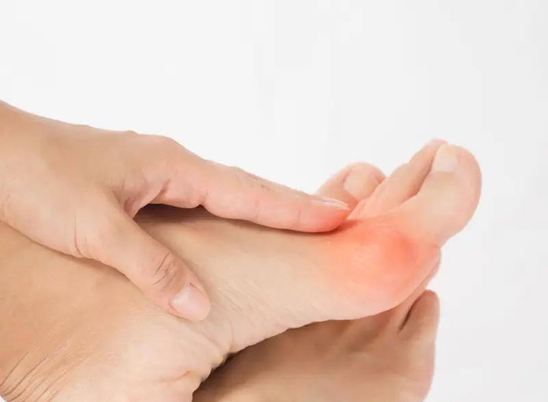 bunion on a foot