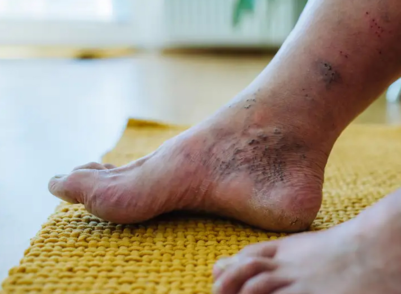 diabetic footcare, image of a foot with diabetic symptoms