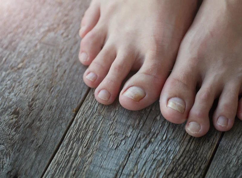 Fungal toenails