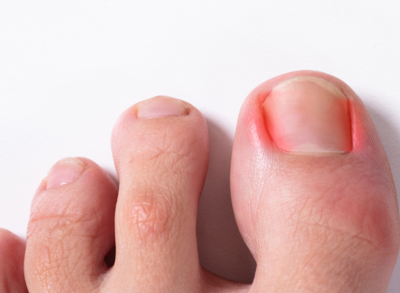 ingrown toenails