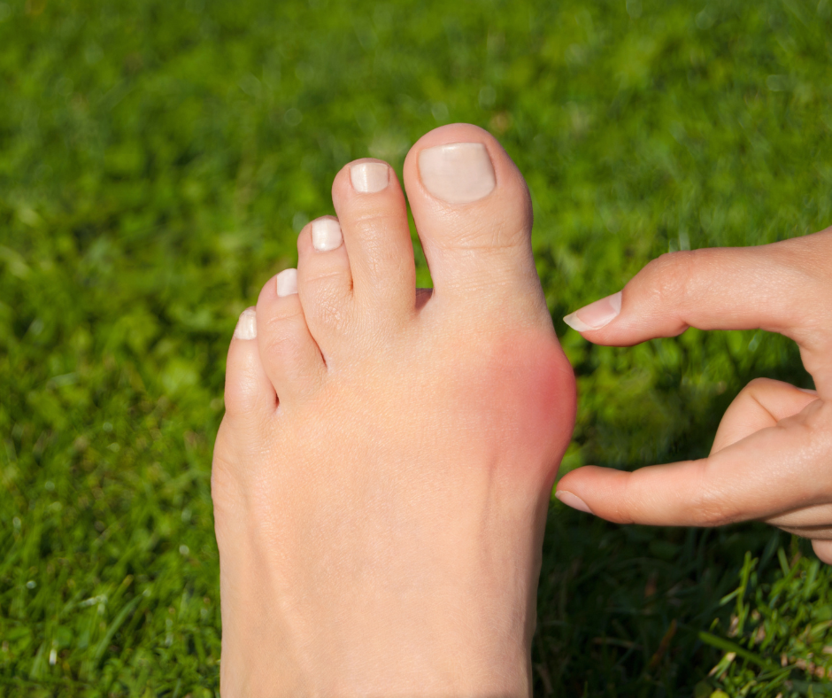 foot with bunion