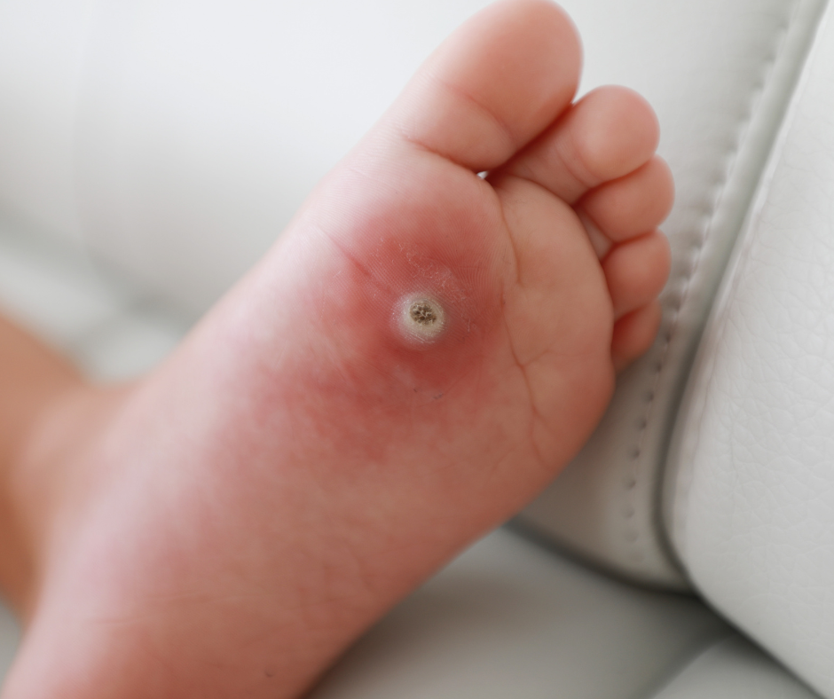 plantar wart on foot