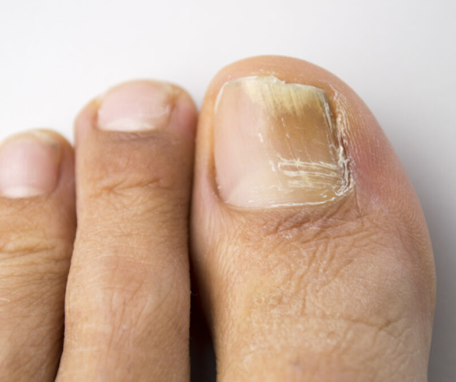 toenail fungus